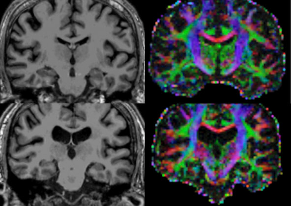File:ME-CFS Brain Images.jpg