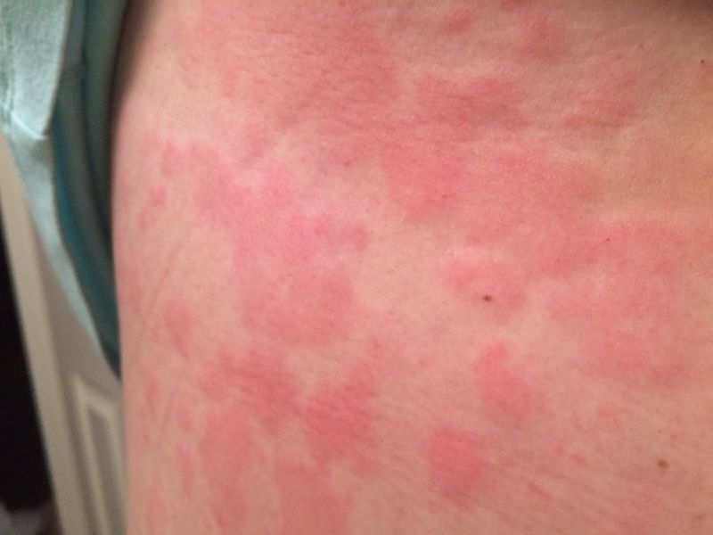File:Example of hives from mast cell activation disorder.jpg