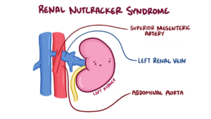 Nutcracker Syndrome Anatomy.png