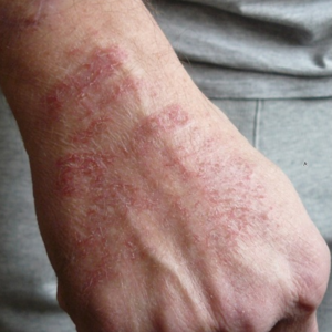 Electrohypersensitivity MCS skin lesions.png