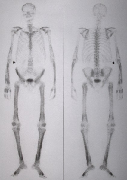 File:Whole body bone scan.jpg