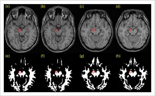 File:Progressive Brain Changes Longitudinal MRI Study (2016).jpeg