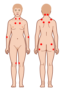 Fibromyalgia notable studies - MEpedia