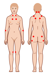 File:Fibro Tender Points.png