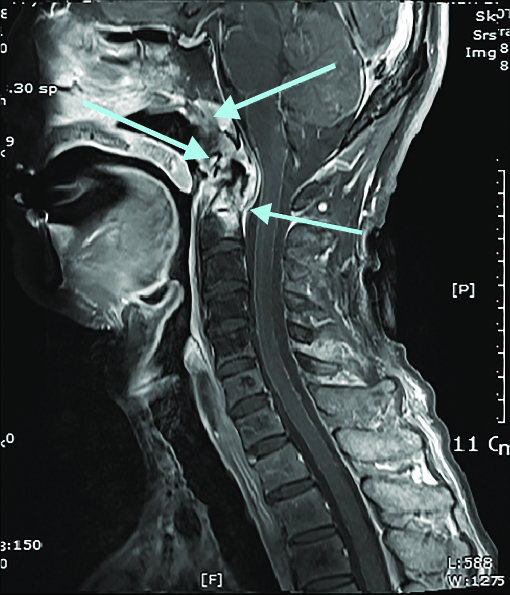 Craniocervical instability MEpedia