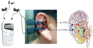 Transcutaneous auricular vagus nerve stimulation as a potential