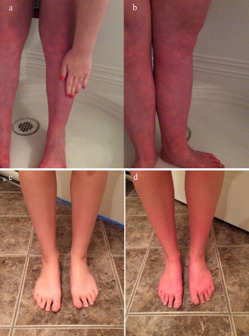 Why Do My Legs Go Purple And Blotchy When I Stand