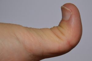 Ehlers-Danlos syndrome - Thumb
