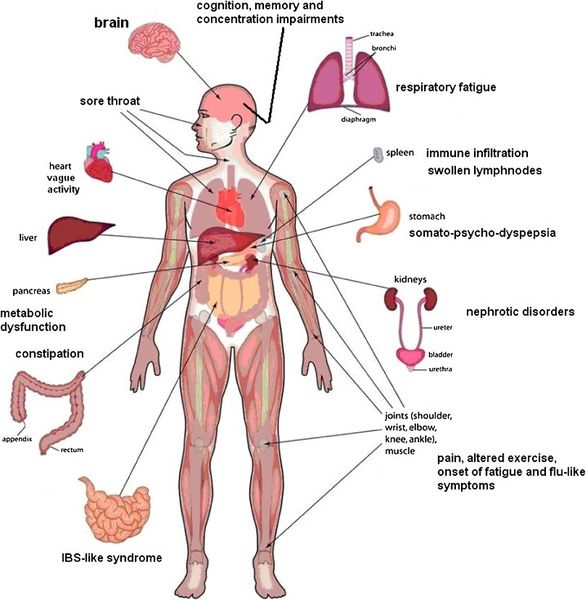 File:Chronic Fatigue Syndrome-symptoms-diagram.jpg