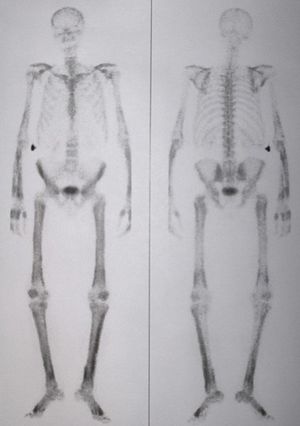 Whole body bone scan.jpg