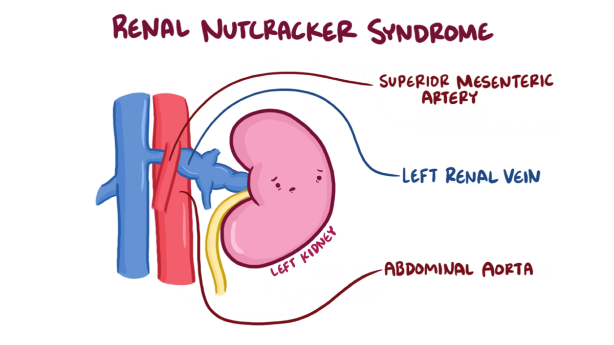 Nutcracker phenomenon - MEpedia