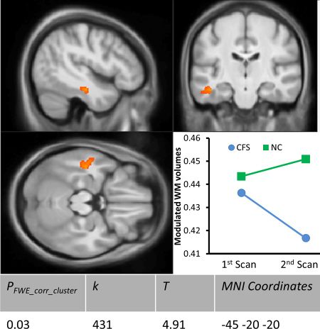 brain scans showing brain changes