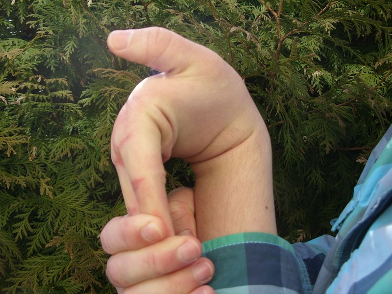 File:Hypermobile (double jointed) phalangeal joints.JPG