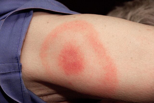 Lyme disease - MEpedia