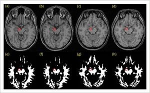 Progressive Brain Changes Longitudinal MRI Study (2016).jpeg
